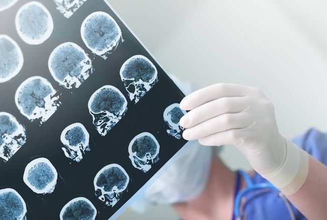 Une simple scintigraphie cérébrale peut détecter précocement la maladie d'Alzheimer avec une précision inégalée